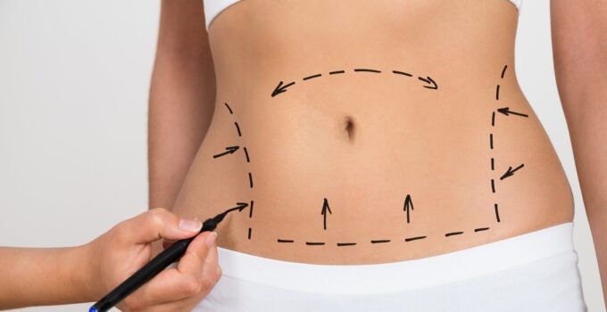 How Much Does a Tummy Tuck Cost in 2024