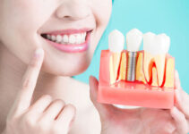 Pros and Cons of Getting Dental Implants Abroad