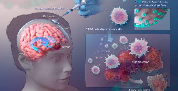 Future Of Glioblastoma Treatment