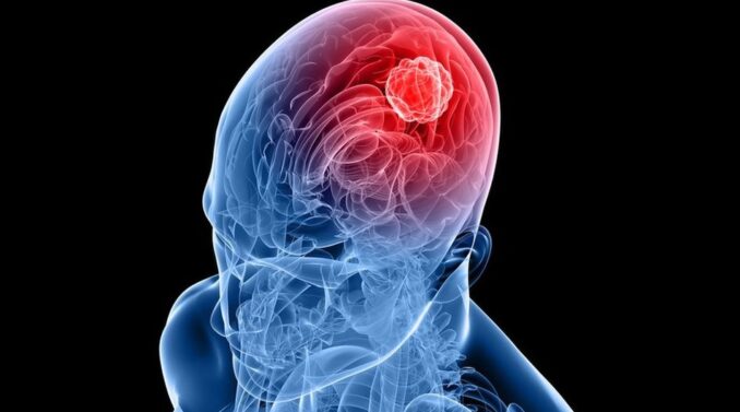 Understanding Glioblastoma